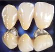 Răng Sứ Kim Loại Ni-Cr